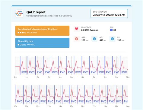 What Accelerated Idioventricular Rhythm Looks Like on Your Watch ECG | Qaly