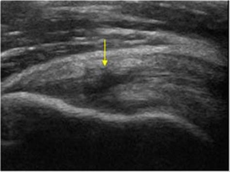 Musculoskeletal Joints And Tendons 61 Shoulder Case 618 Rotator