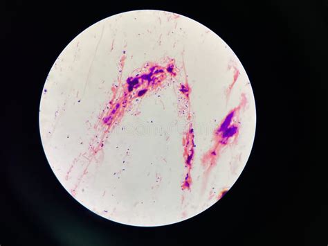 Gram Stain of Arcanobacterium Haemolyticum Colony Showing Irregularly ...