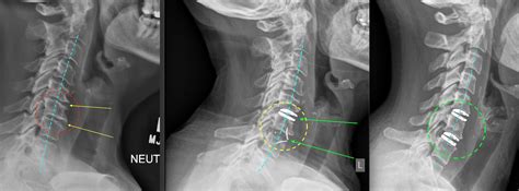 Anterior Cervical Spinal Reconstruction Cutting Edge Hybrids And