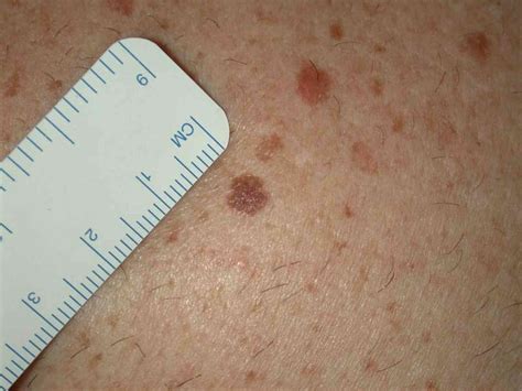 Spot the difference: harmless mole or potential skin cancer?