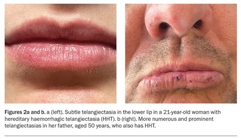 Hereditary Haemorrhagic Telangiectasia Diagnosis Screening And