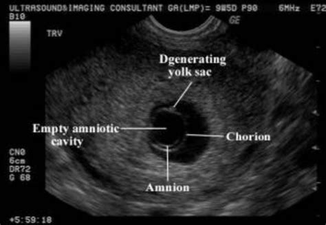 Dms Obgyn Ch First Trimester Complications Flashcards Quizlet