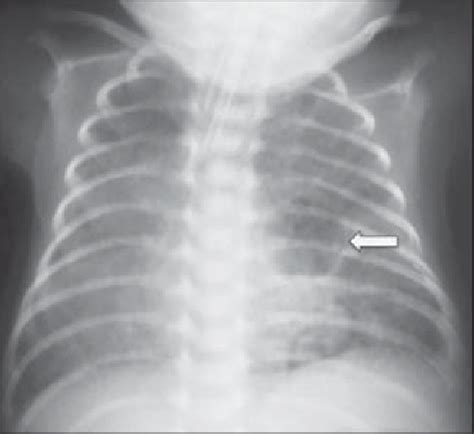 Anteroposterior Chest Radiography Bilateral Hypoattenuating