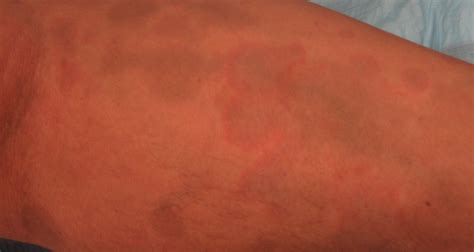 Erythema Dyschromicum Perstans