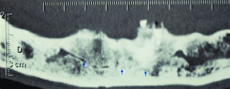 Mandibular Incisive Canal Arrows Courtesy Of Dr Alp Alantar