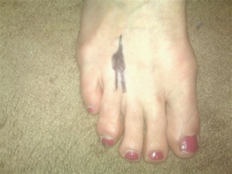 Hammer Toe Causes And Cure - Maritza Blinks