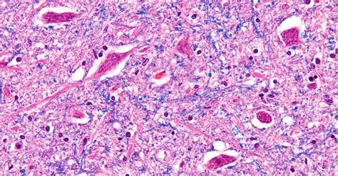 Motor neurons: definition, types and pathologies