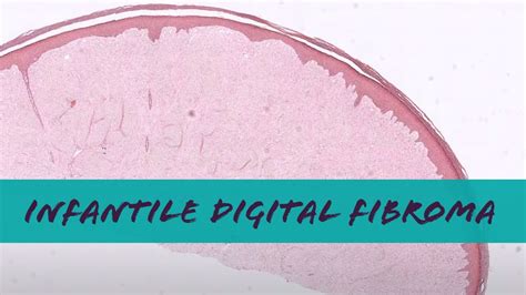 Infantile Digital Fibroma Inclusion Body Fibromatosis Pathology