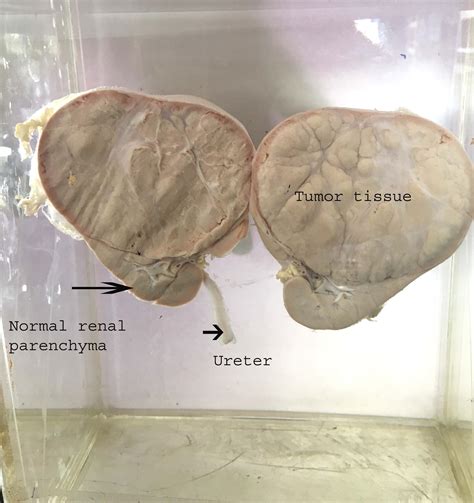 Wilms Tumor Gross Histopathology Guru