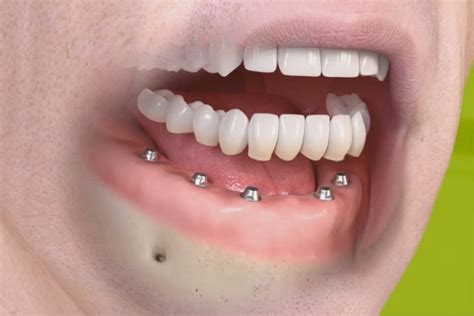 Qual o preço de um implante dentário Fatores que impactam