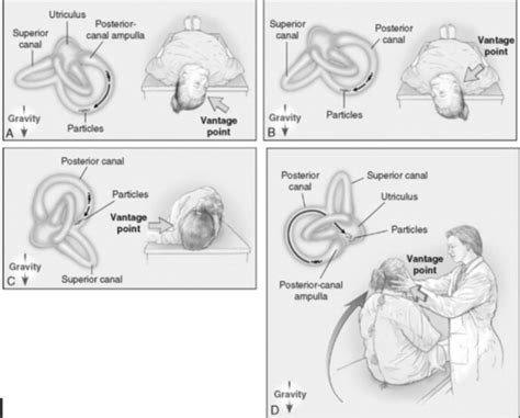 The Basics of BPPV Flashcards | Quizlet