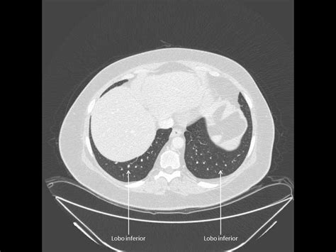 Anatomia Tc De TÓrax