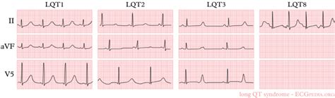 File Lqts1 3 Png ECGpedia