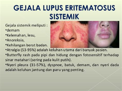 Lupus Adalah Penyakit Apa Homecare