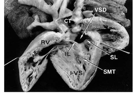 Photograph Of A Human Specimen With Common Arterial Trunk Persistent