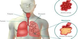 Qu Causa La Neumonia En Ancianos Detectarla Y Evitarla