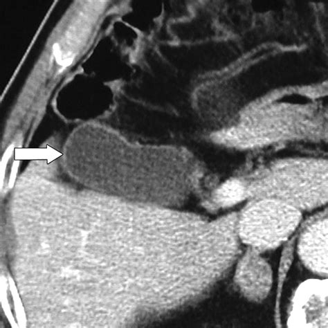 Radiofrequency Ablation Of Hepatic Tumors Adjacent To The Gallbladder