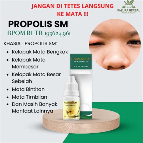 Jual Obat Kelopak Mata Bengkak, Kelopak Mata Membesar, Kelopak Mata ...