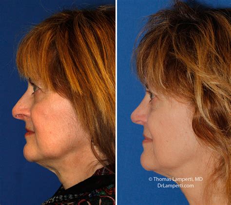 Hanging Columella Rhinoplasty In Seattle Rhinoplasty Surgeon