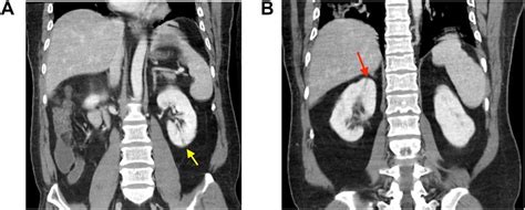 A Linear Wedge Shaped Infarct In Left Kidney Yellow Arrow On