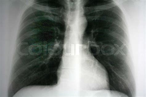 X-ray of a lung. Photo icon for health and disease. | Stock image ...