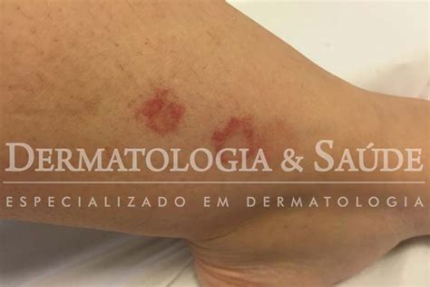 Manchas Vermelhas Nas Pernas O Que Pode Ser Dermatologia E Saude