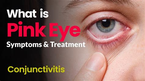 Signs And Symptoms Of Pink Eye Conjunctivitis Off