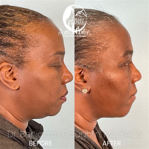 Combination Of Jawline Sculpting Chin Implant Fat Transfer Before