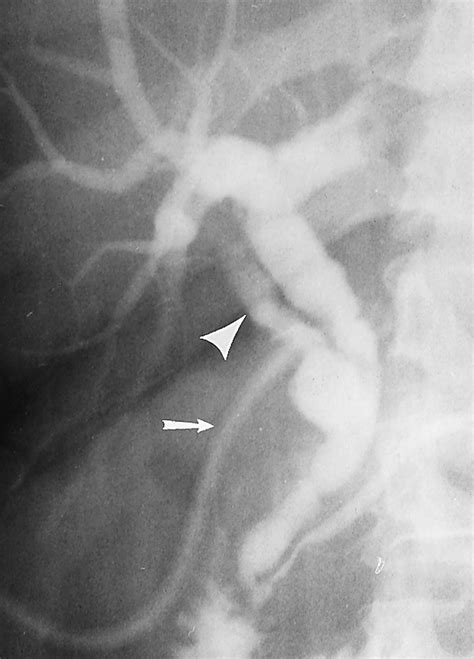 The Cystic Duct Normal Anatomy And Disease Processes Radiographics