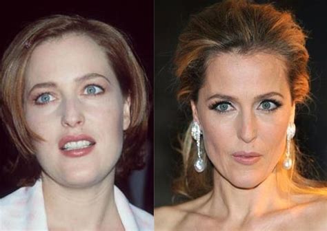 Gillian Anderson before and after plastic surgery (12) | Celebrity ...