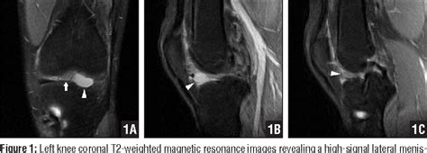 Figure 1 From Misdiagnosis Of An Atypical Cyclops Lesion 4 Years After