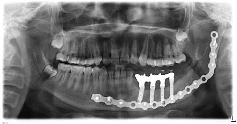 Radiografía panorámica de control de instalación de implantes