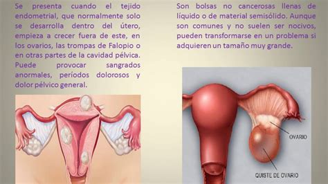 Enfermedades Del Sistema Reproductor Femenino Abstractor