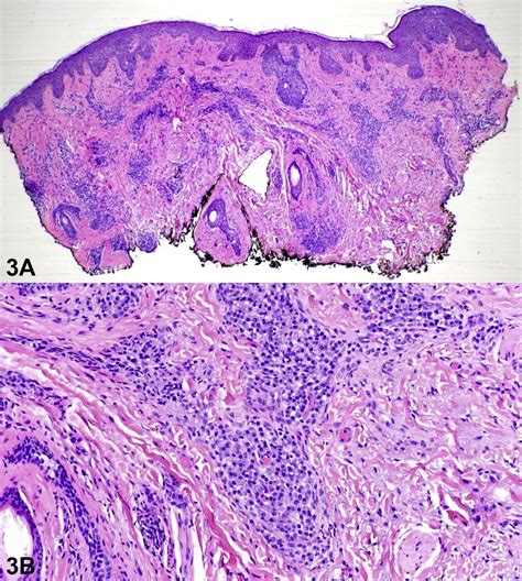 Asymptomatic Reddish Brown Papules And Plaques In An Elderly Japanese Woman Jaad Case Reports