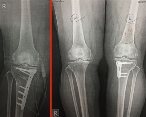 การผ่าตัดเปลี่ยนแนวกระดูกข้อเข่าให้ตรง High Tibial Osteotomy Hto