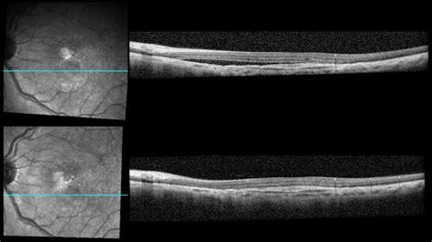 Wet Age Related Macular Degeneration Wet Amd Statpearls Ncbi