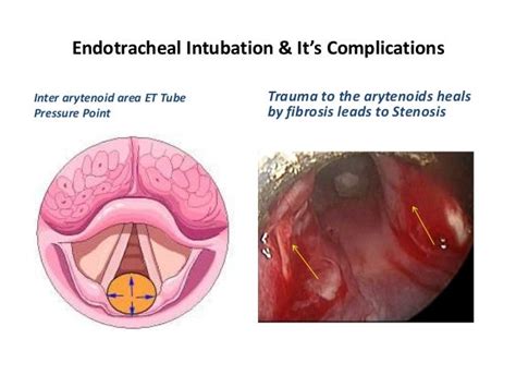 Endotracheal intubation & its complications