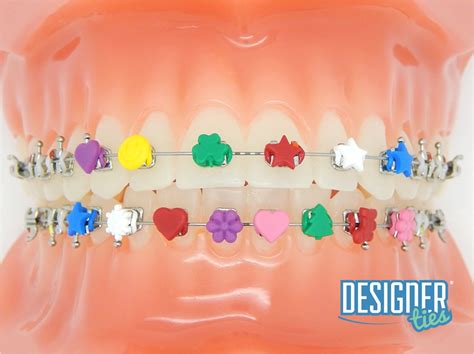 Ligature Ties Come in Fun Shapes and Colors - Dentistry Today