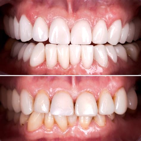 Smile Transformation Dentfirst Dental Care