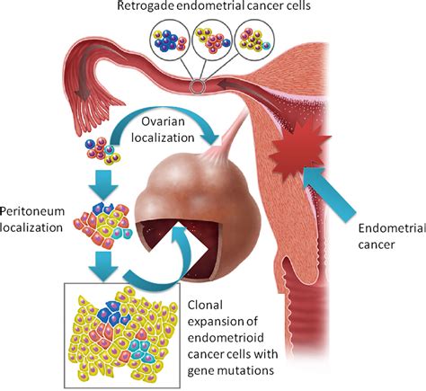 Frontiers Endometrioid Cancer Associated With Endometriosis From The