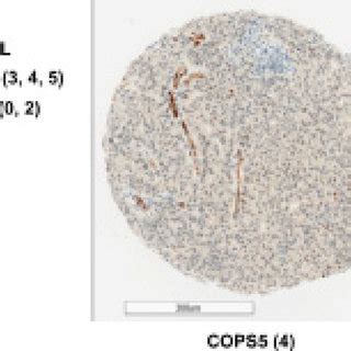 COPS5 Expression Is Positively Correlated With SNAIL Expression In Lung