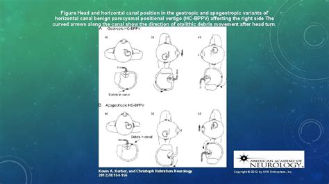 DIAGNOSIS AND TREATMENT OF BPPV FOR PHYSICAL THERAPY