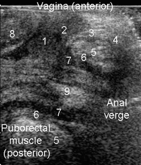 Ultrasonographic Anatomy Of Perineal Structures During Pregnancy And