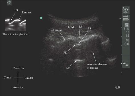 Spine Sign Ultrasound