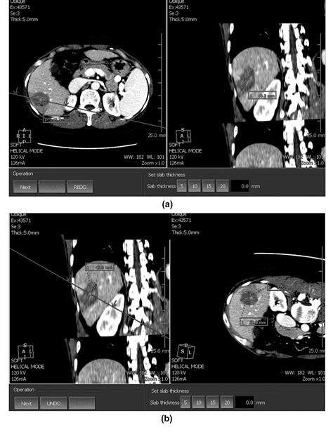 Figure 1 From Percutaneous Ultrasonography Guided Radiofrequency