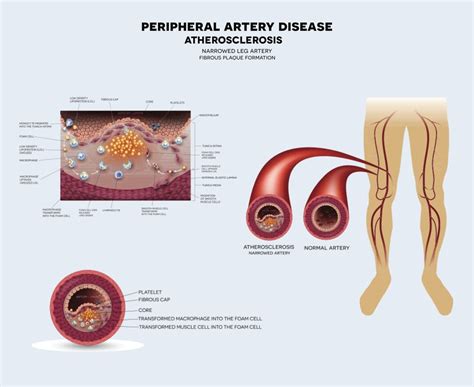 Peripheral Artery Diseases Risk Symptoms Diagnosis And Treatment