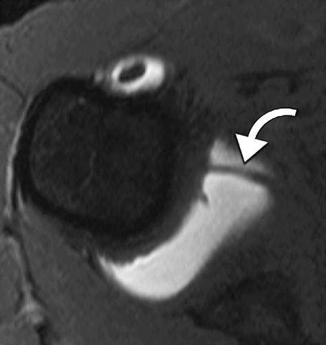 Axial image at the level of the humeral neck just below the humeral ...