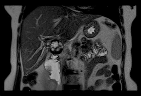 imaging shows  heterogeneous hyperintense lesion    signal