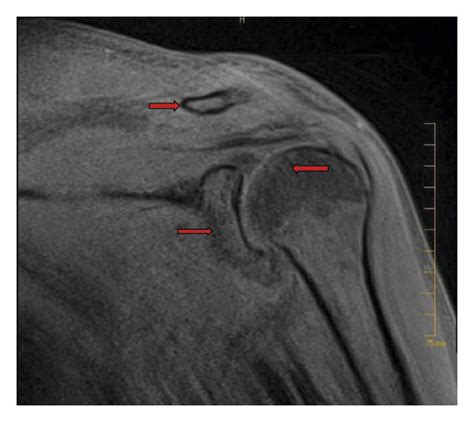 Mri Left Shoulder Revealed Acromioclavicular Joint Synovitis With